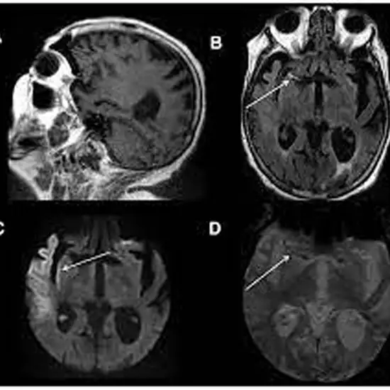 MRI Brain Stroke Protocol
